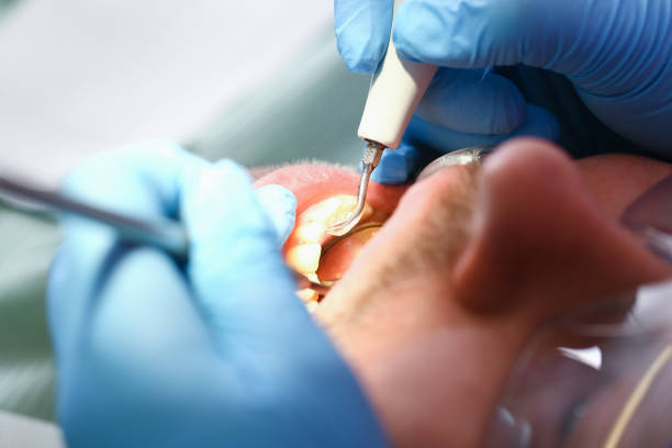Best Emergency Tooth Extraction in Bay, AR