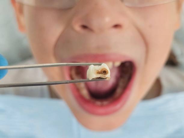 Best Emergency Treatment for Dental Infections or Abscesses in Bay, AR